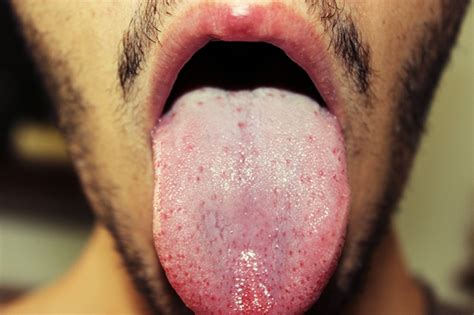 Help What Can My Tongue Tell You At Candida