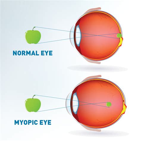 myopia control richard hughes opticians