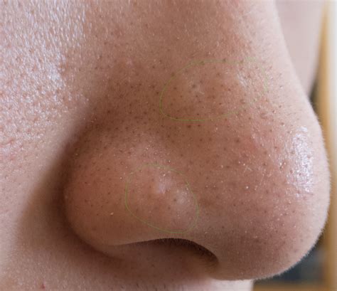 [with pictures] flesh colored bumps on nose hypertrophic raised