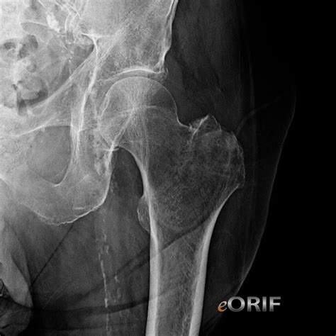 greater trochanter hip fracture sa  eorif
