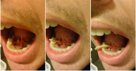 Watch This Man Push A Salivary Stone Out Of His Mouth
