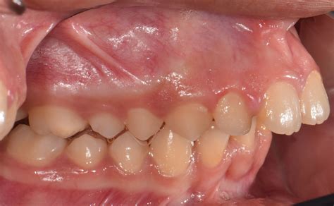 teeth protrusion dr khaled alkateb