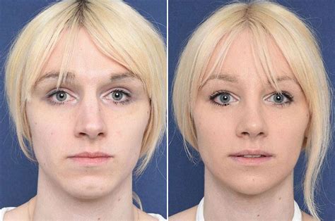 jaw reduction feminizing the jaw 2pass clinic