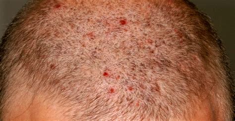 Is There Any Cure For Folliculitis Of The Scalp Hemorrhoids Remedies