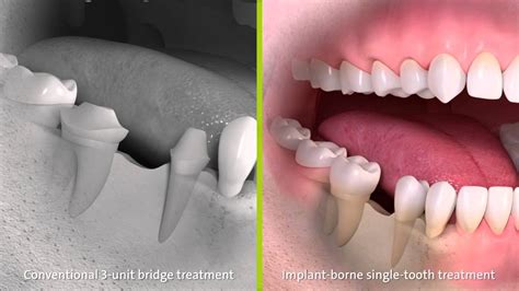 straumann conventional  unit bridge treatment implant borne single tooth treatment youtube