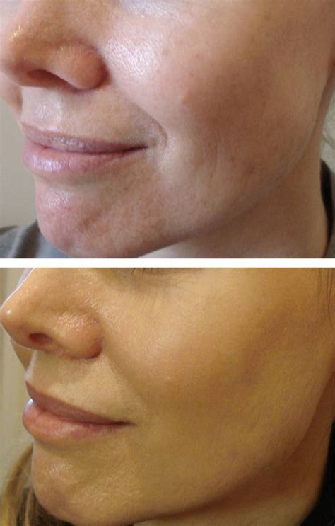 fractional laser before and afters Áda aesthetic medicine