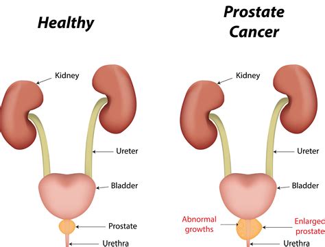 symptom  prostate cancer