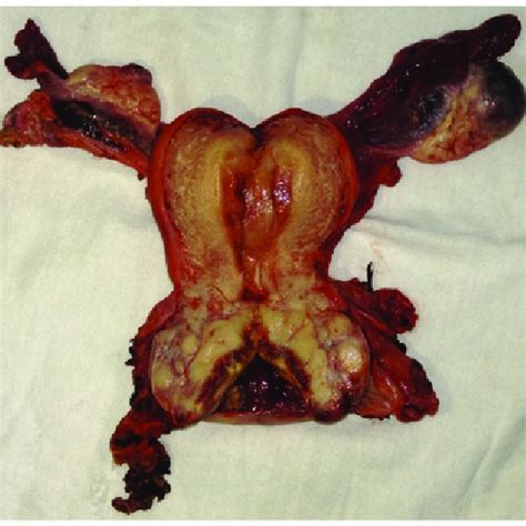 Large Tumor Of The Uterine Cervix Download Scientific Diagram