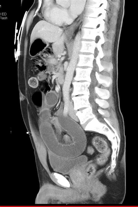 small bowel obstruction due  adhesions small bowel case studies