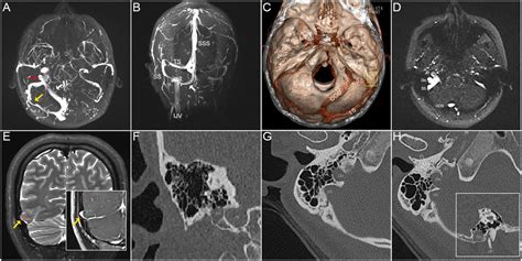 frontiers case report venous pulsatile tinnitus induced  enlarged