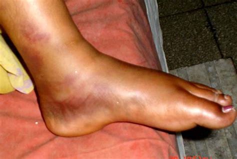 5 causes of swollen feet ankles