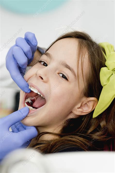 Girl At Orthodontist Stock Image F024 3926 Science Photo Library