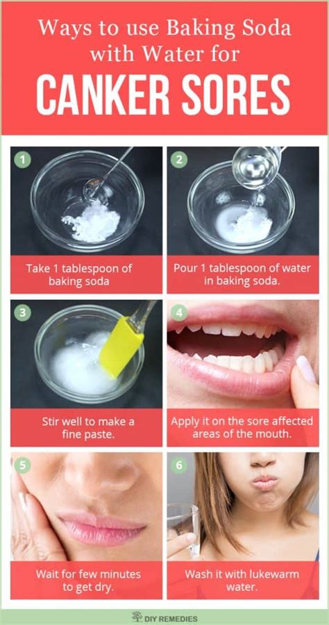 5 best ways to use baking soda for canker sores