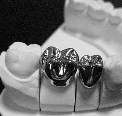 base metal alloy dentalcrowncom