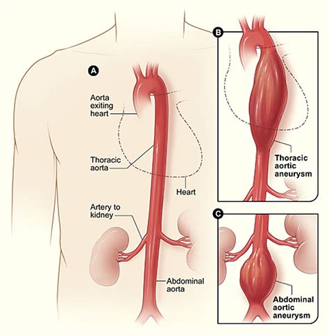 aortic aneurysm abdominal thoracic  symptoms repair