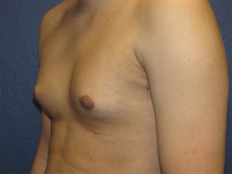 puberty breast development