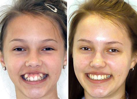 Before And After Braces Bored Panda