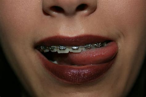 226 best images about braces on pinterest posts black braces and pink braces
