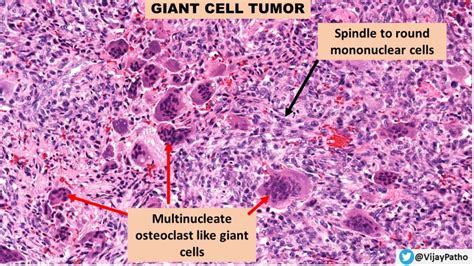 giant cell tumor bone pathology  simple