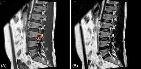 mri scan sagittal view lumbosacral spine  straight vrogueco