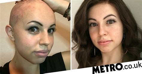 Woman Who Shaved Her Head Due To Trichotillomania Becomes