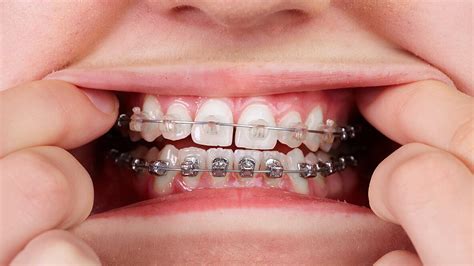 braces    metal braces  ceramic braces