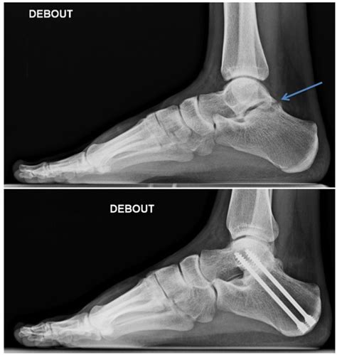 arthrodesis foot  ankle institute