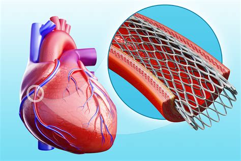 heart stent procedure   blocked operation