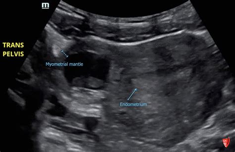 Intern Ultrasound Of The Month Ectopic Pregnancy — University