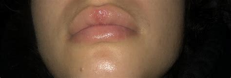 my upper lip has been peeling or getting irritated this happened after