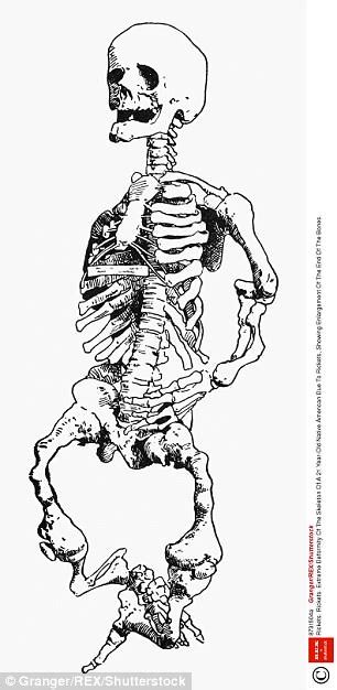 dickensian diseases including rickets gout and syphilis