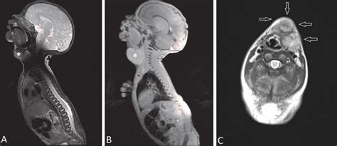 a b sagittal t2 a and t1 weighted b mri images showing a