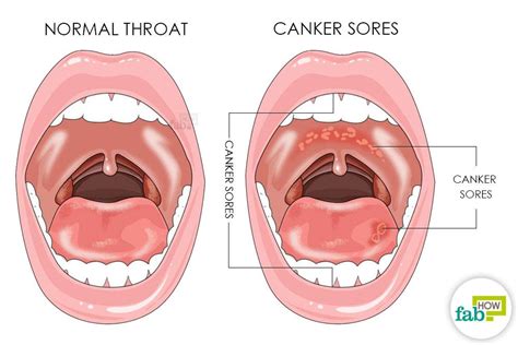 How To Get Rid Of Canker Sores Fab How