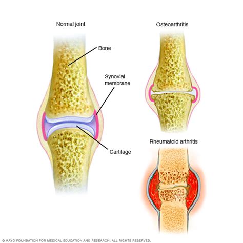 Rheumatoid Arthritis Disease Reference Guide
