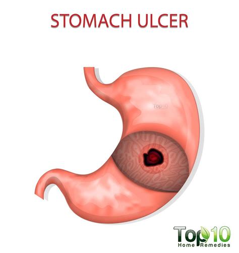 10 Signs And Symptoms Of A Stomach Ulcer You Should Not Ignore Top 10