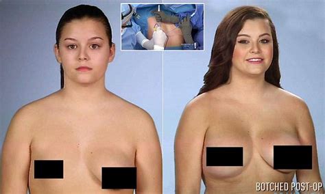 Woman Left With Only One Breast Has Surgery To Finally Get