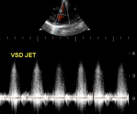 echocardiographic profile  ventricular septal defect video