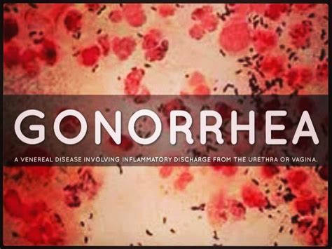 Untitled — Gonorrhoea Is Becoming Untreatable Who Warns