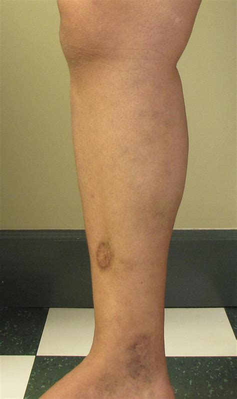 Leg Ulcer Treatment Orange County Leg Ulcers Newport Beach