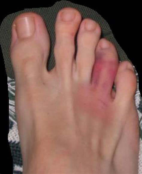healthool sprained toe symptoms  broken big toe treatment images