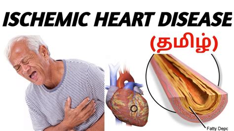 ischemic heart disease causes signs and symptoms