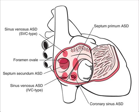 atrial ventricular  atrioventricular septal defects obgyn key