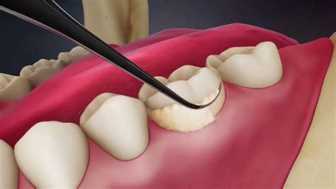 dental scaling   procedures youtube