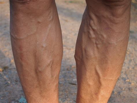 men  women  suffer  vein disease heall