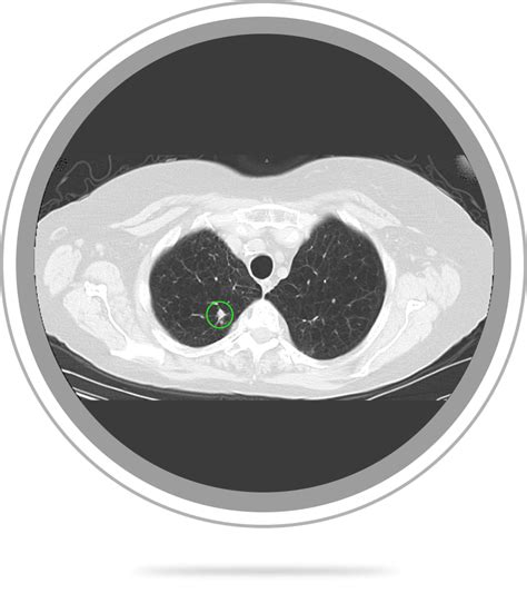 lung nodule treatment information