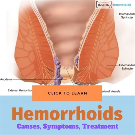 hemorrhoids types causes symptoms treatment and prevention