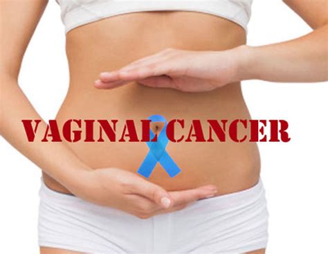 Vaginal Cancer Symptoms Causes And Treatment Home Health Beauty Tips