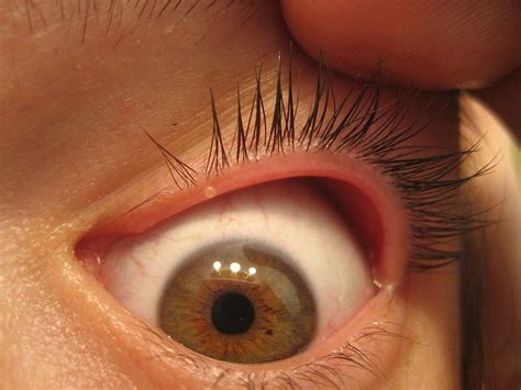 symptoms    blepharitis health save blog blepharitis eye infections