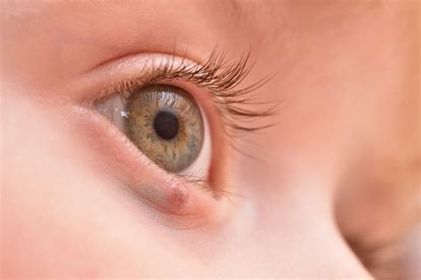 eyelid cancer types symptoms  treatment