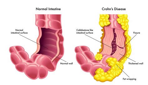 crohns disease guide  symptoms  treatment options